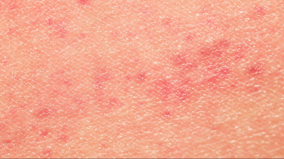 Haut mit Rötungen durch Schmuckallergie – gerötete Haut als typische Reaktion auf Schmuckmetalle wie Nickel, Gold oder Silber, Kontaktdermatitis und allergische Hautreaktionen erkennen und vermeiden